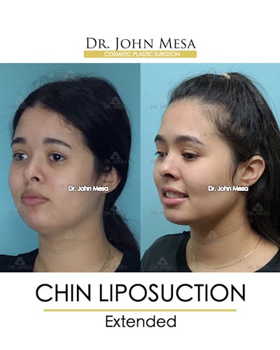 Chin Liposuction Before & After Gallery - Patient 148735143 - Image 4