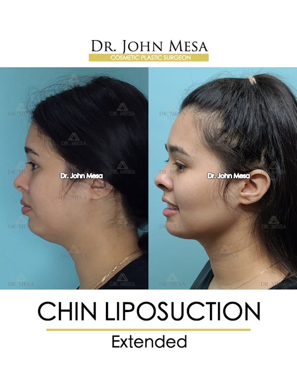Chin Liposuction Before & After Gallery - Patient 148735143 - Image 5