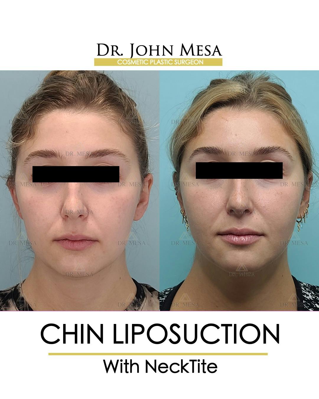 Chin Liposuction Before & After Gallery - Patient 148735144 - Image 1