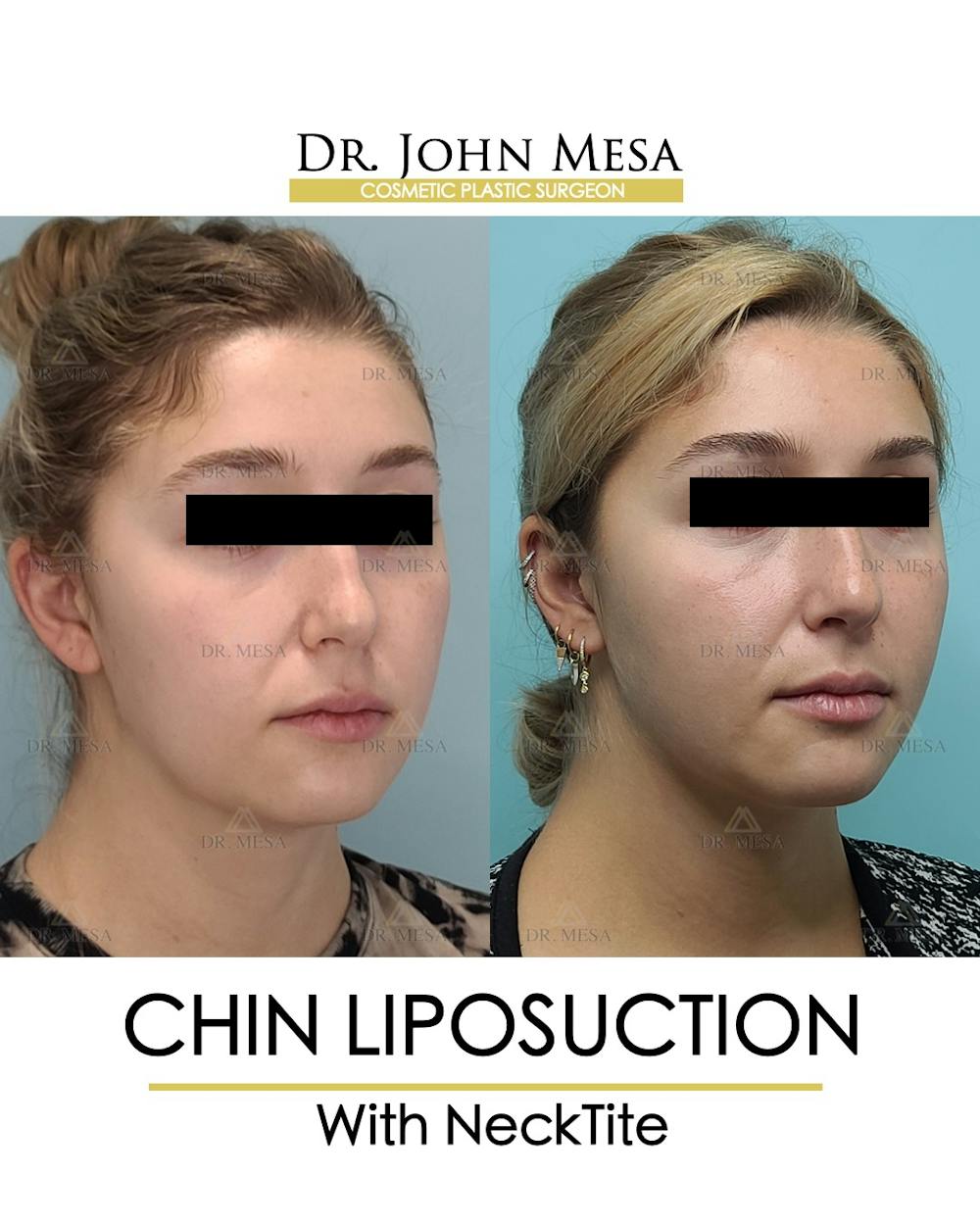 Chin Liposuction Before & After Gallery - Patient 148735144 - Image 3