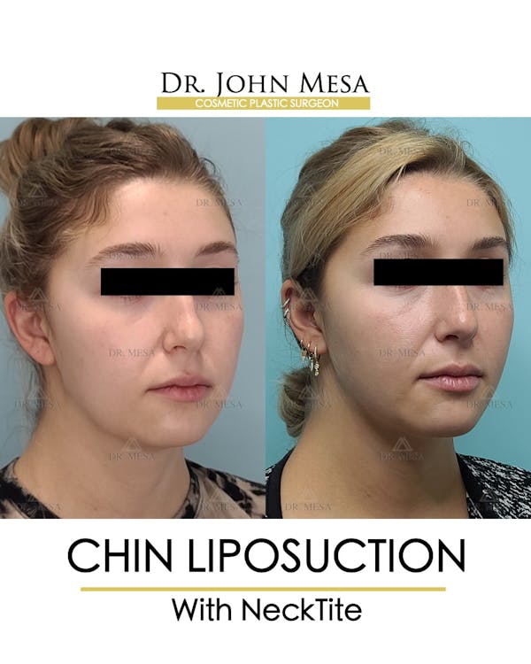 Chin Liposuction Before & After Gallery - Patient 148735144 - Image 2