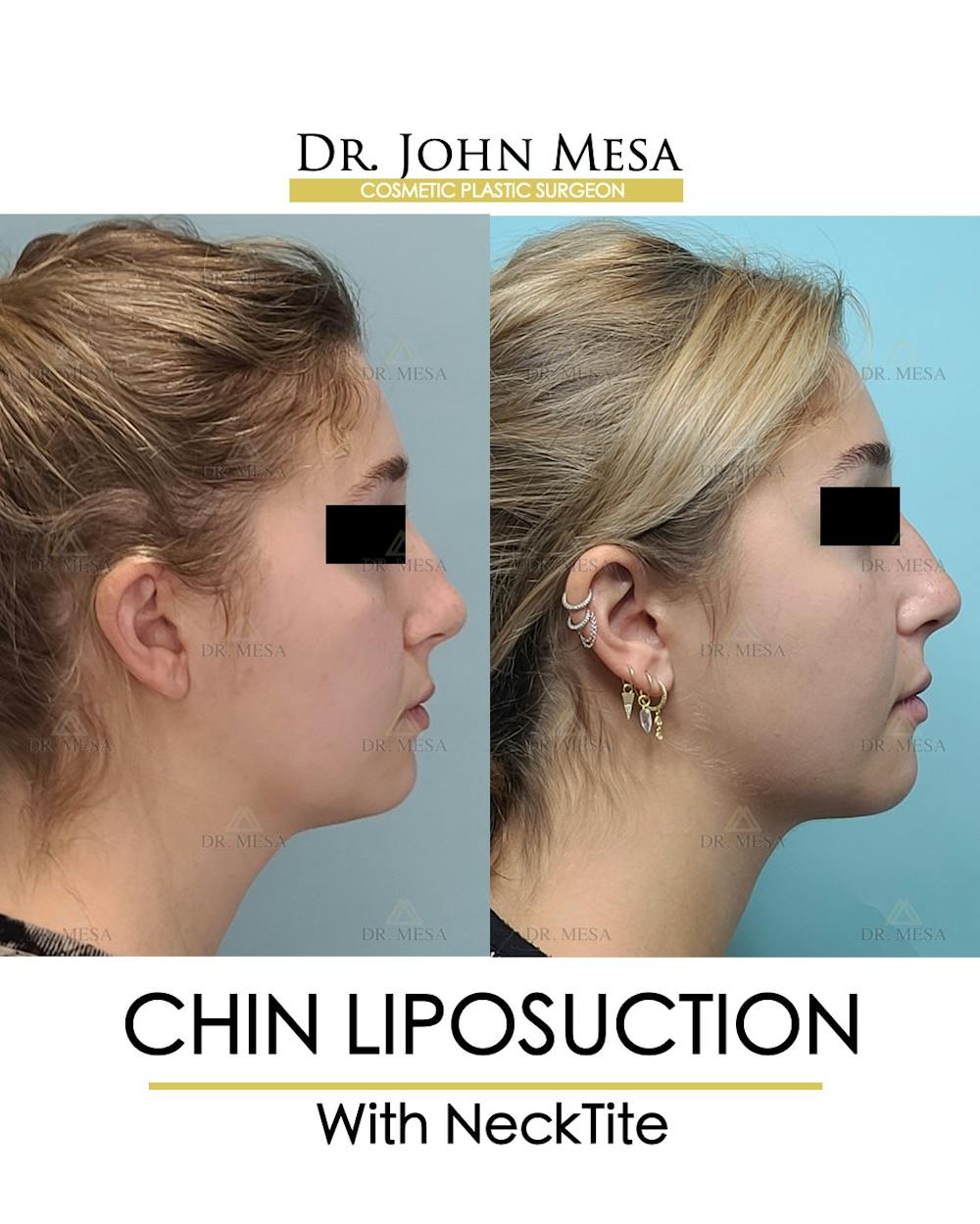 Chin Liposuction Before & After Gallery - Patient 148735144 - Image 3
