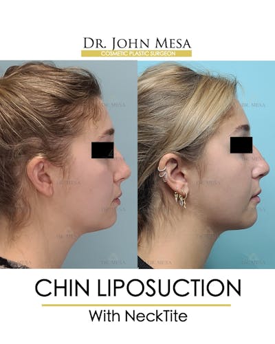 Chin Liposuction Before & After Gallery - Patient 148735144 - Image 1