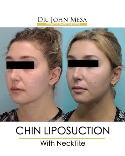 Chin Liposuction Before & After Gallery - Patient 148735144 - Image 4