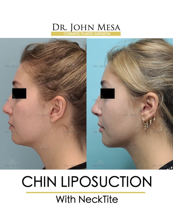 Chin Liposuction Before & After Gallery - Patient 148735144 - Image 5