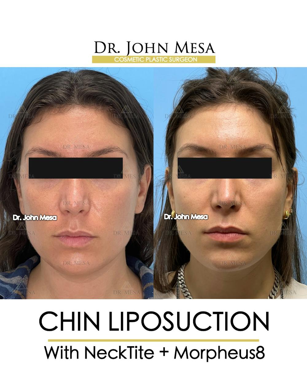 Chin Liposuction Before & After Gallery - Patient 148735145 - Image 2