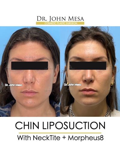 Chin Liposuction Before & After Gallery - Patient 148735145 - Image 2