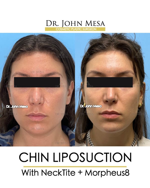 Chin Liposuction Before & After Gallery - Patient 148735145 - Image 1