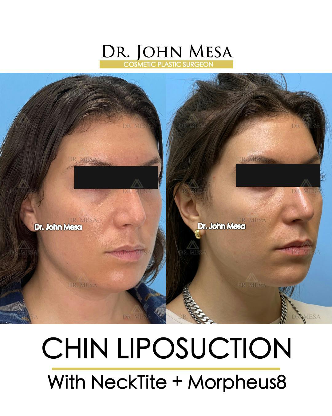 Chin Liposuction Before & After Gallery - Patient 148735145 - Image 2