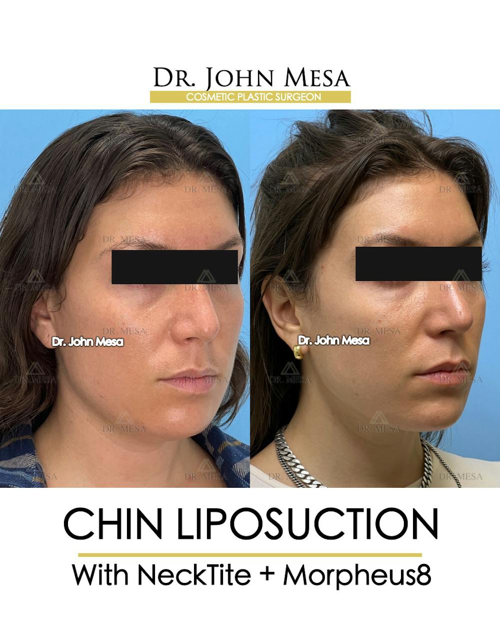 Chin Liposuction Before & After Gallery - Patient 148735145 - Image 3