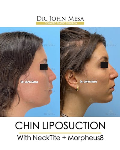 Chin Liposuction Before & After Gallery - Patient 148735145 - Image 1