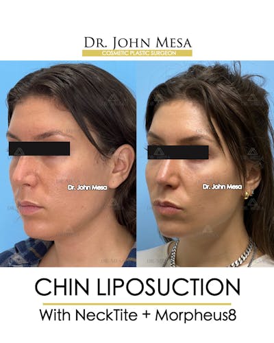 Chin Liposuction Before & After Gallery - Patient 148735145 - Image 4