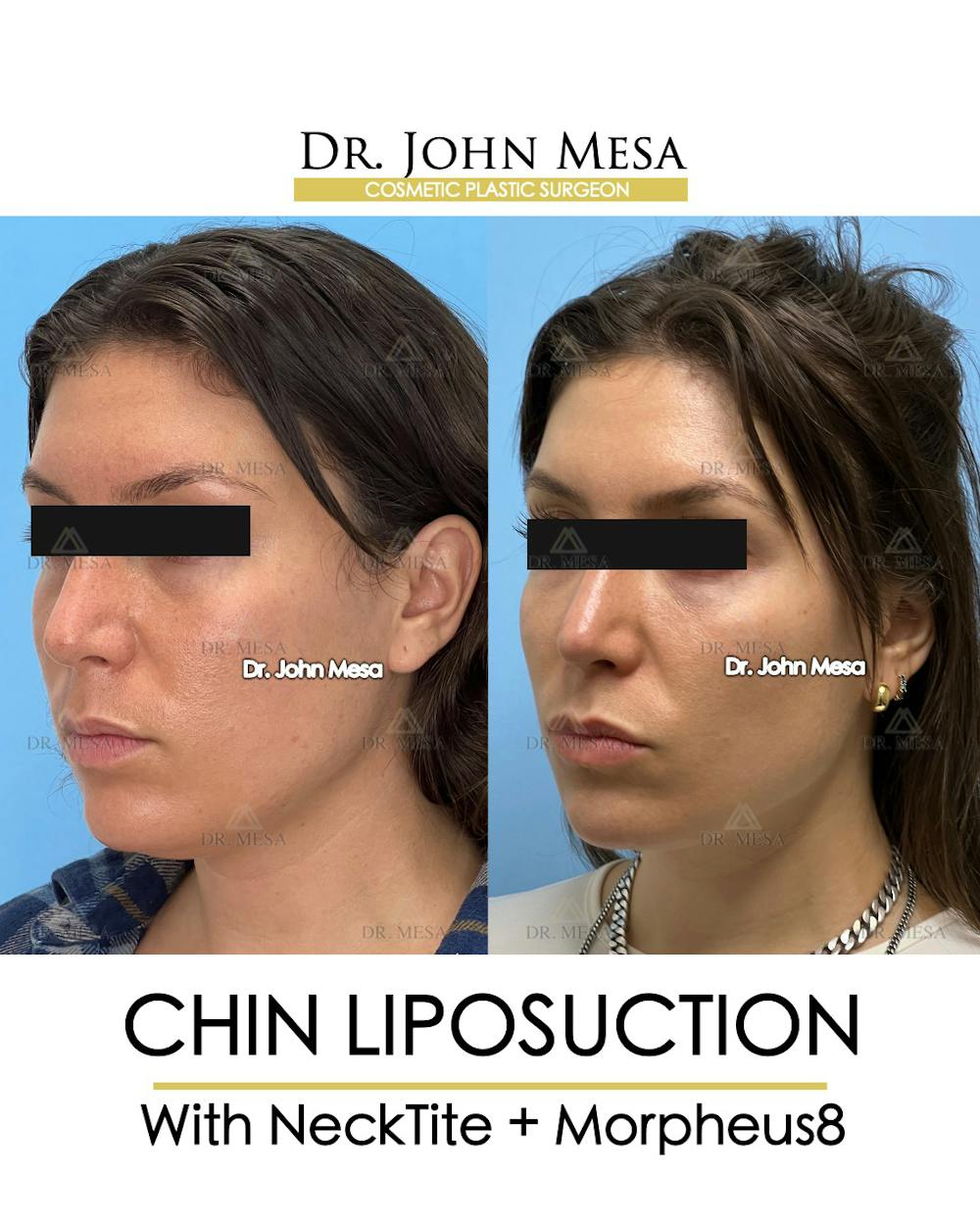 Chin Liposuction Before & After Gallery - Patient 148735145 - Image 4