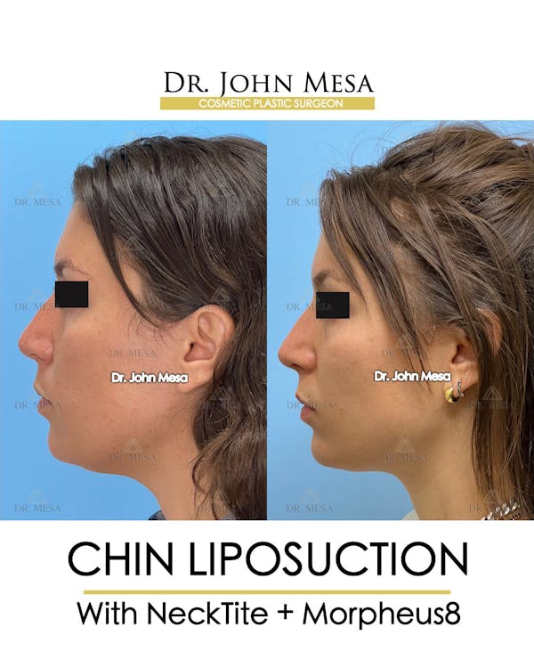 Chin Liposuction Before & After Gallery - Patient 148735145 - Image 5