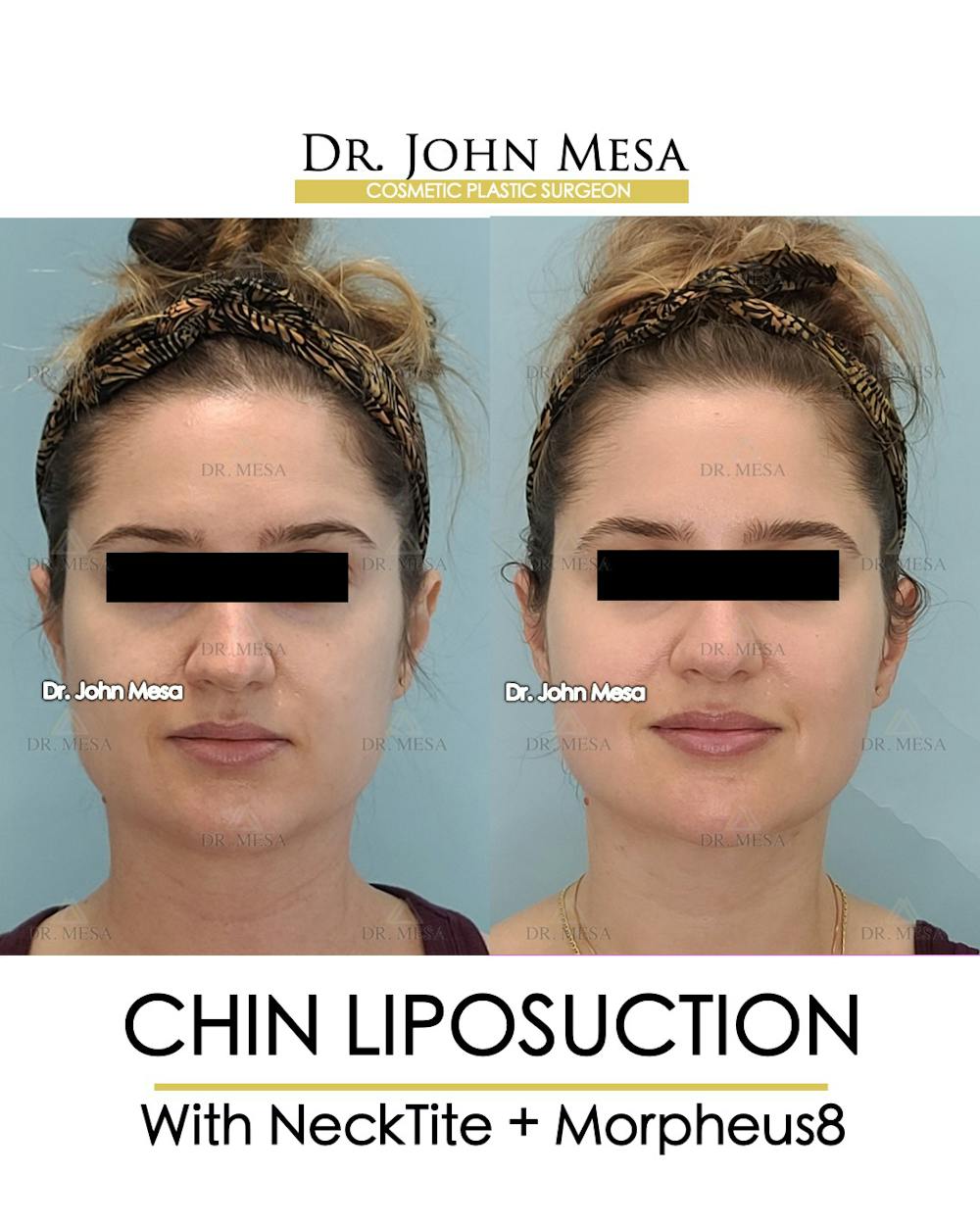 Chin Liposuction Before & After Gallery - Patient 148735146 - Image 2