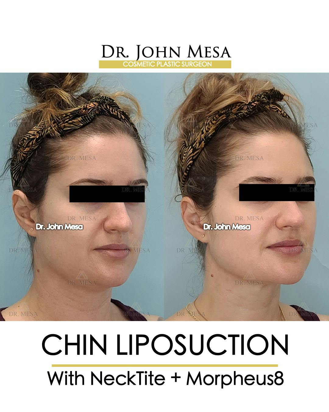 Chin Liposuction Before & After Gallery - Patient 148735146 - Image 2