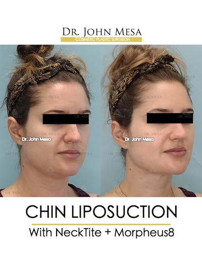 Chin Liposuction Before & After Gallery - Patient 148735146 - Image 2