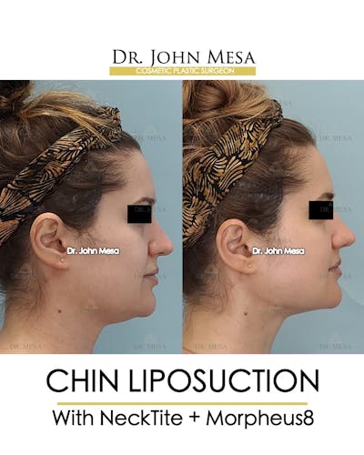 Chin Liposuction Before & After Gallery - Patient 148735146 - Image 1