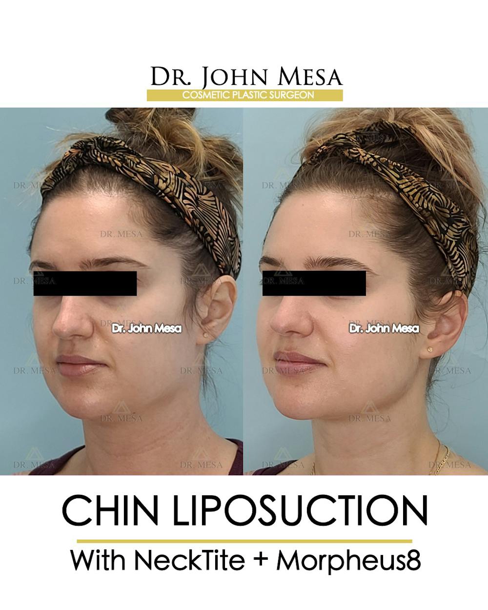 Chin Liposuction Before & After Gallery - Patient 148735146 - Image 4