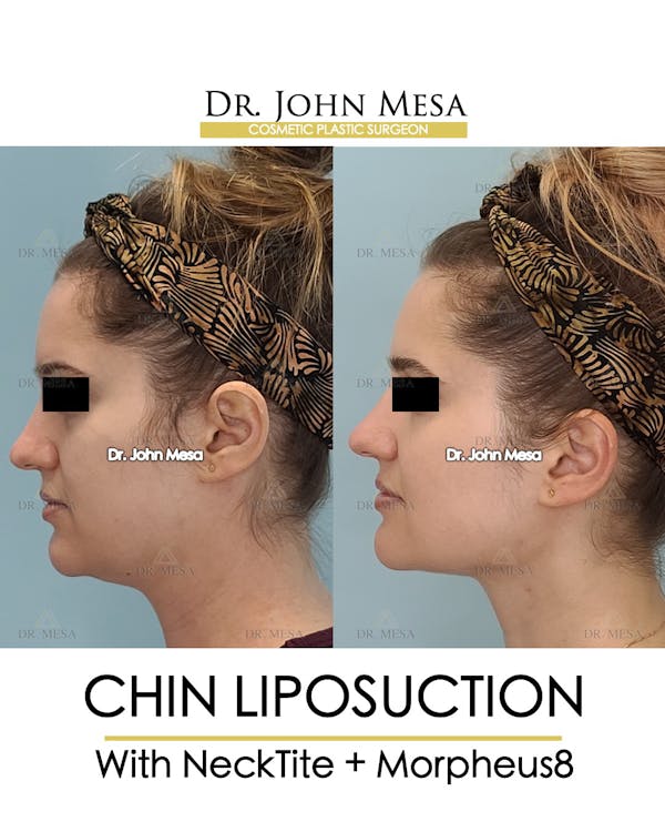 Chin Liposuction Before & After Gallery - Patient 148735146 - Image 5