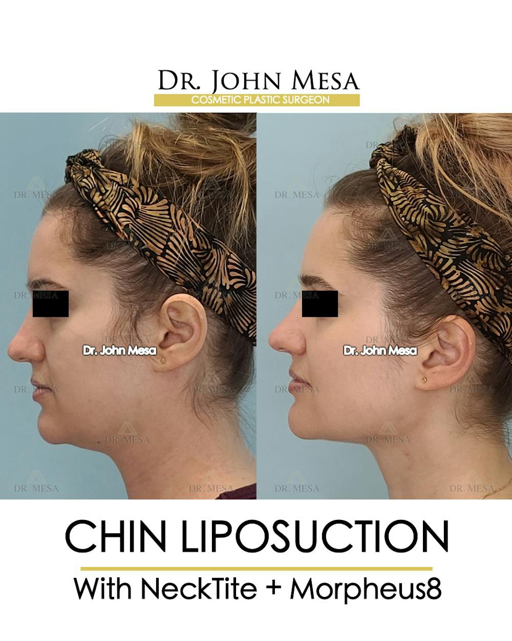 Chin Liposuction Before & After Gallery - Patient 148735146 - Image 5