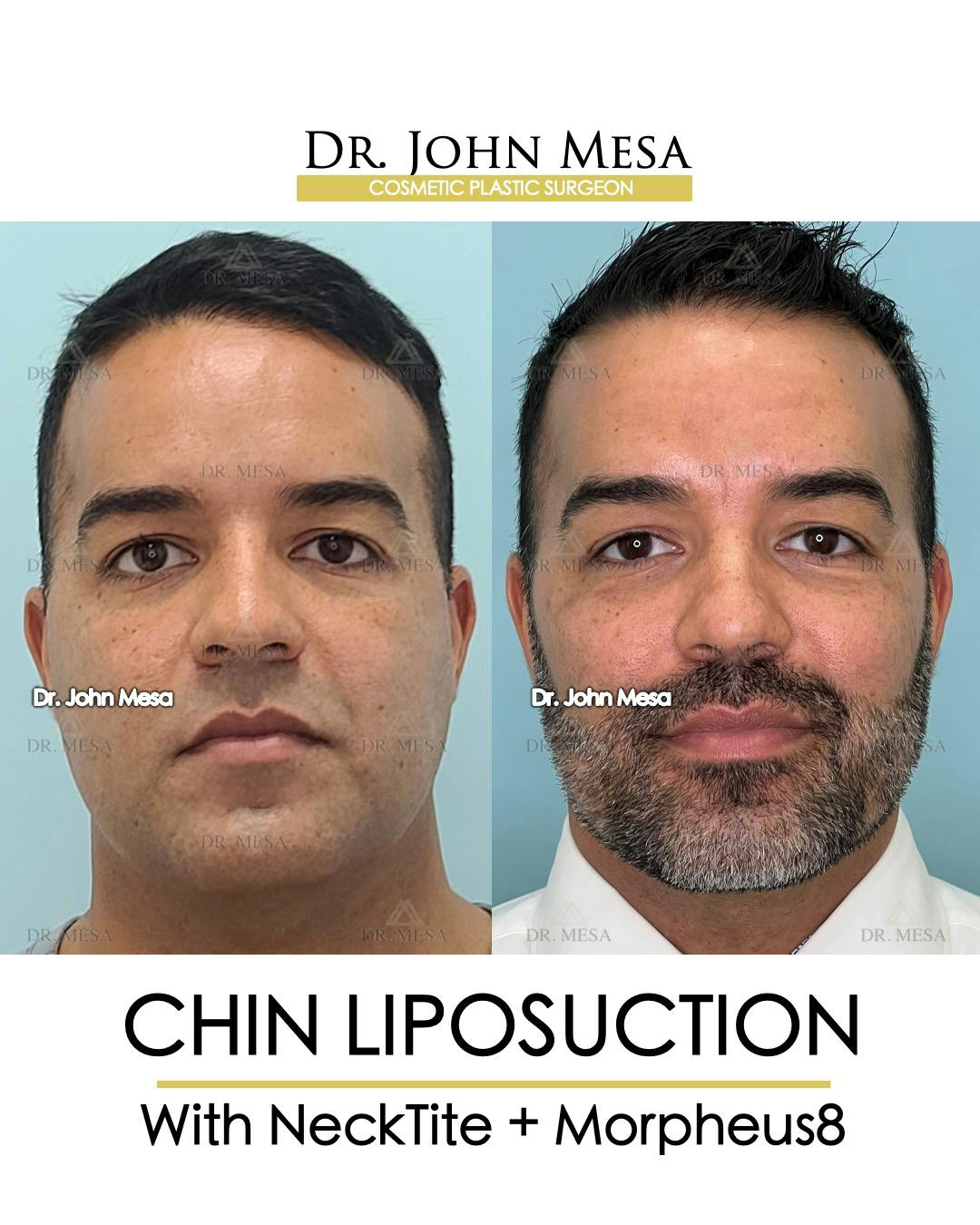 Chin Liposuction Before & After Gallery - Patient 148735273 - Image 1