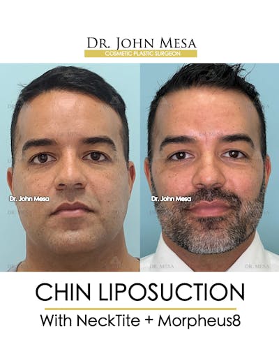 Chin Liposuction Before & After Gallery - Patient 148735273 - Image 1