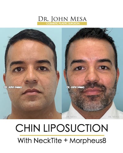 Chin Liposuction Before & After Gallery - Patient 148735273 - Image 2