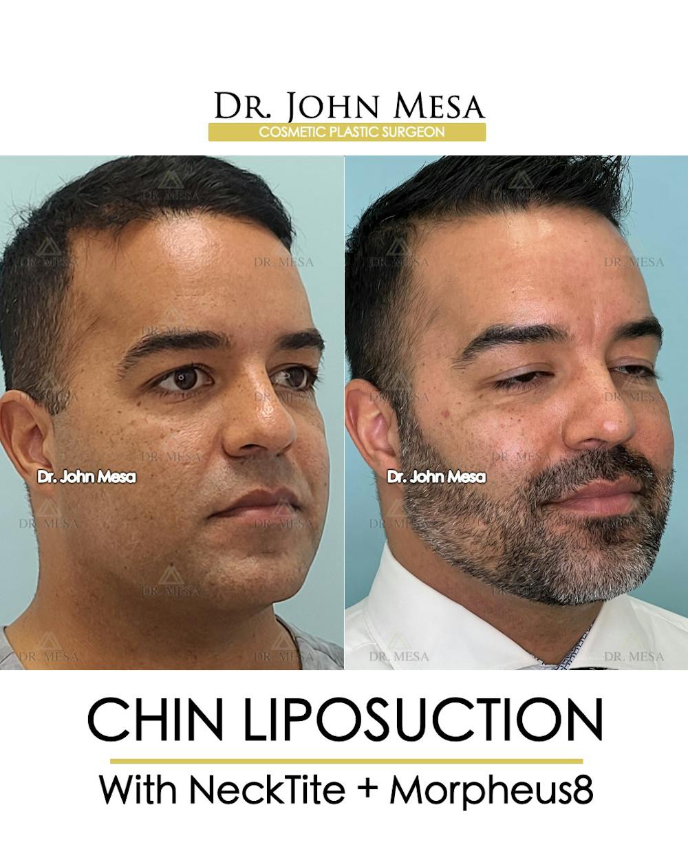 Chin Liposuction Before & After Gallery - Patient 148735273 - Image 3