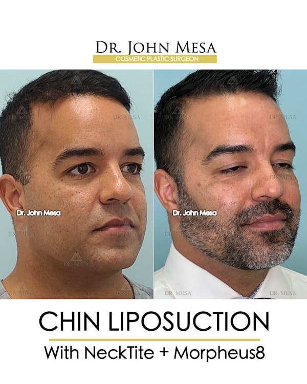 Chin Liposuction Before & After Gallery - Patient 148735273 - Image 2