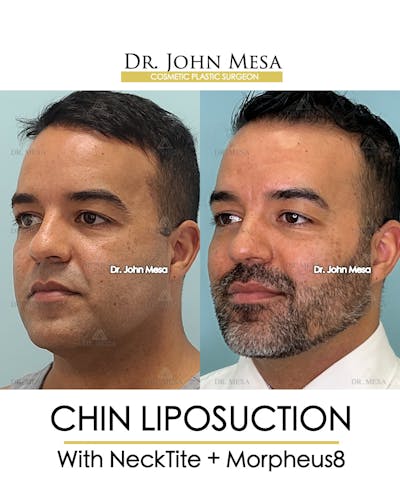 Chin Liposuction Before & After Gallery - Patient 148735273 - Image 4