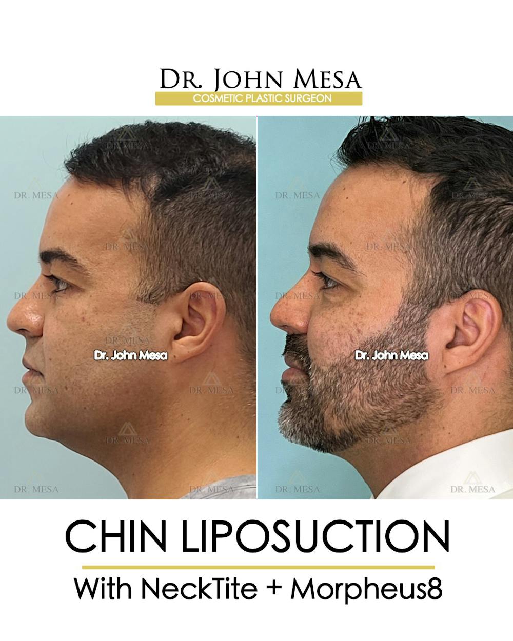Chin Liposuction Before & After Gallery - Patient 148735273 - Image 5