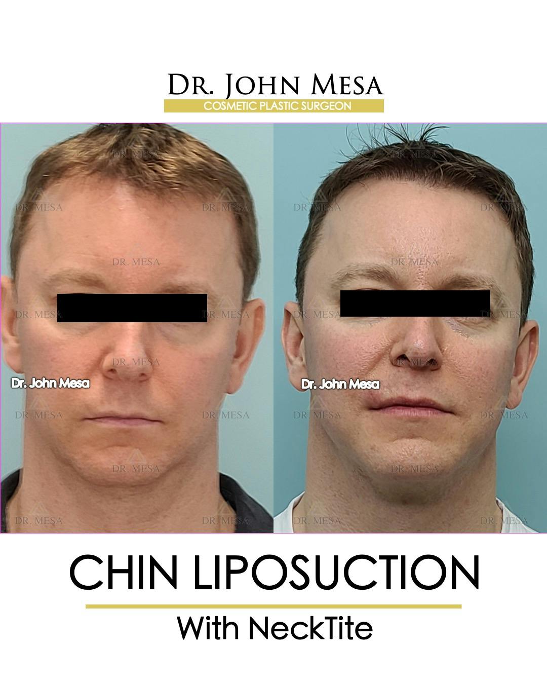 Chin Liposuction Before & After Gallery - Patient 148735269 - Image 1