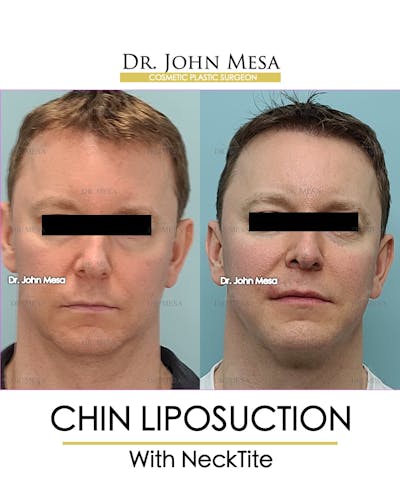 Chin Liposuction Before & After Gallery - Patient 148735269 - Image 1