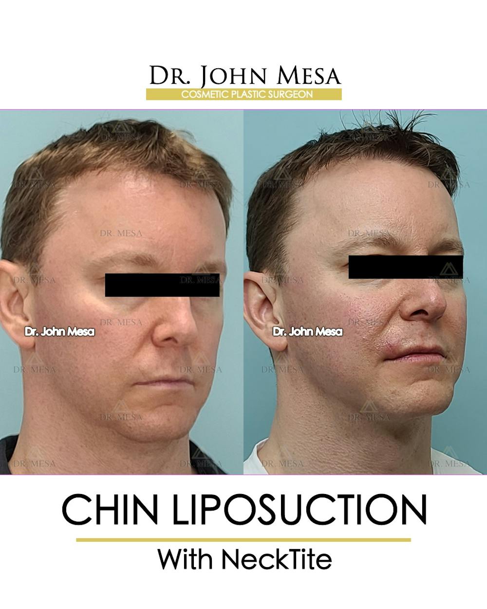 Chin Liposuction Before & After Gallery - Patient 148735269 - Image 3