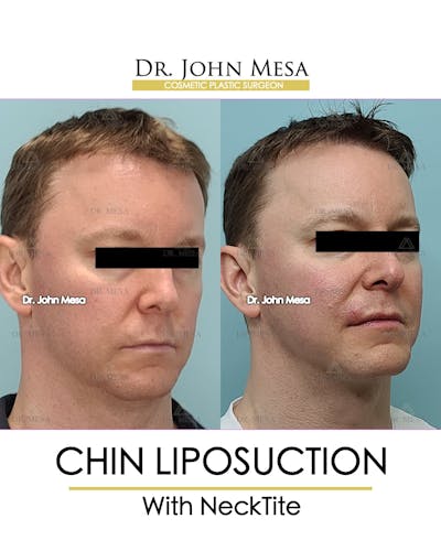 Chin Liposuction Before & After Gallery - Patient 148735269 - Image 2