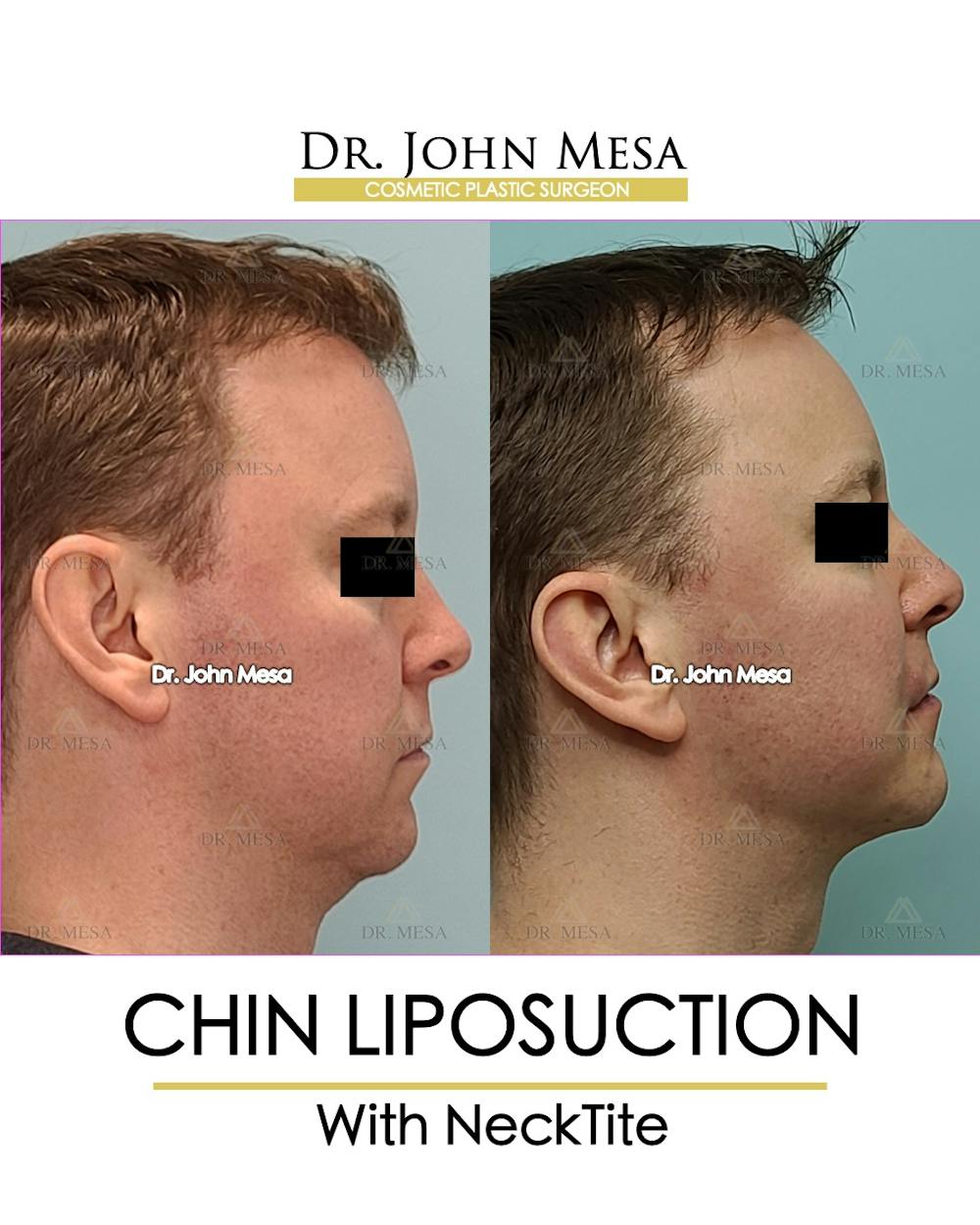 Chin Liposuction Before & After Gallery - Patient 148735269 - Image 1