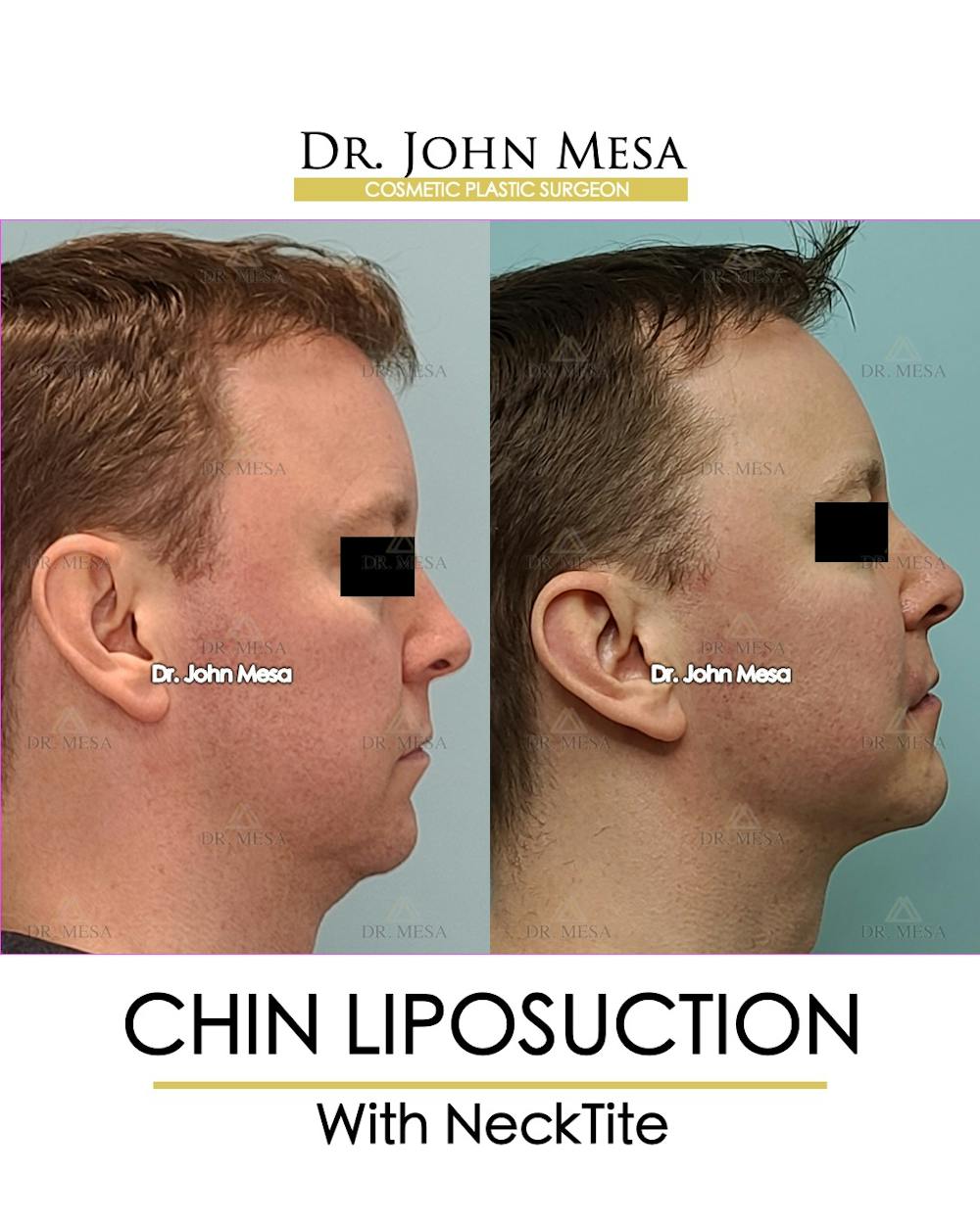 Chin Liposuction Before & After Gallery - Patient 148735269 - Image 3
