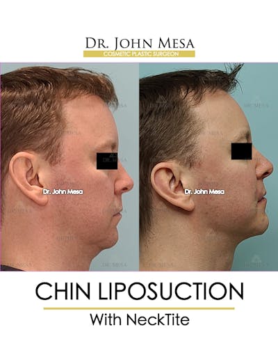 Chin Liposuction Before & After Gallery - Patient 148735269 - Image 1