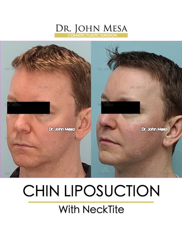 Chin Liposuction Before & After Gallery - Patient 148735269 - Image 4