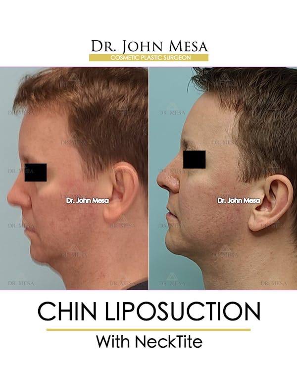 Chin Liposuction Before & After Gallery - Patient 148735269 - Image 5