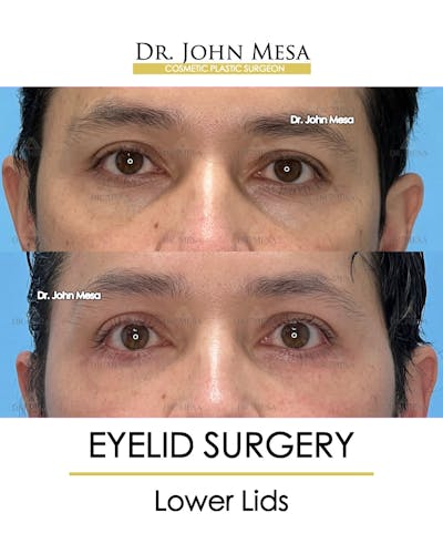 Eyelid Lift Surgery Before & After Gallery - Patient 148735149 - Image 1