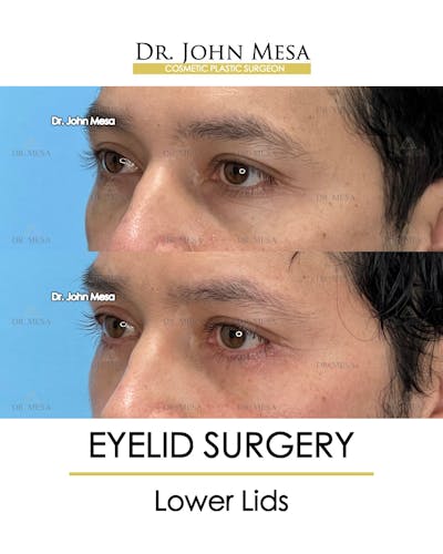 Eyelid Lift Surgery Before & After Gallery - Patient 148735149 - Image 2