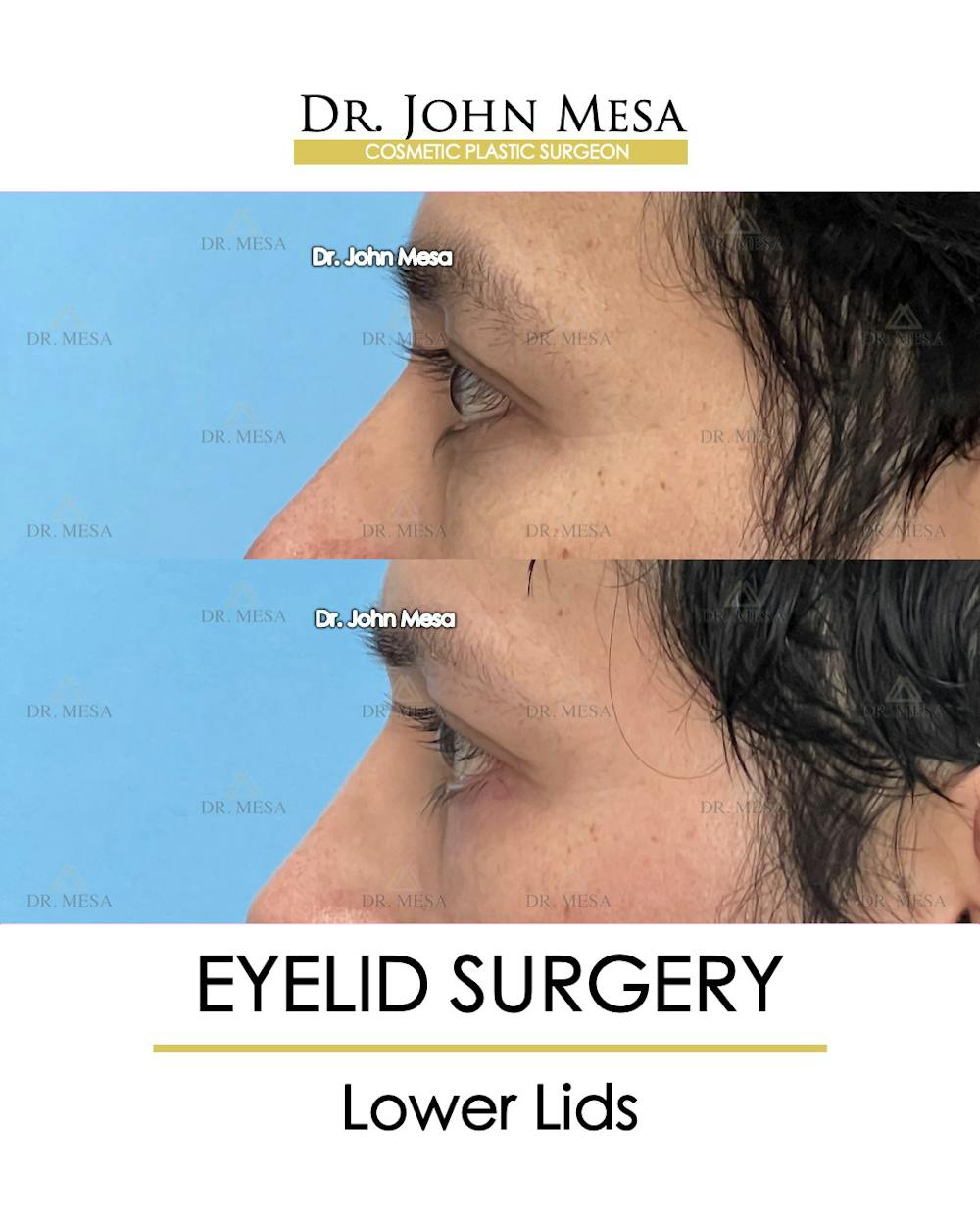 Eyelid Lift Surgery Before & After Gallery - Patient 148735149 - Image 3