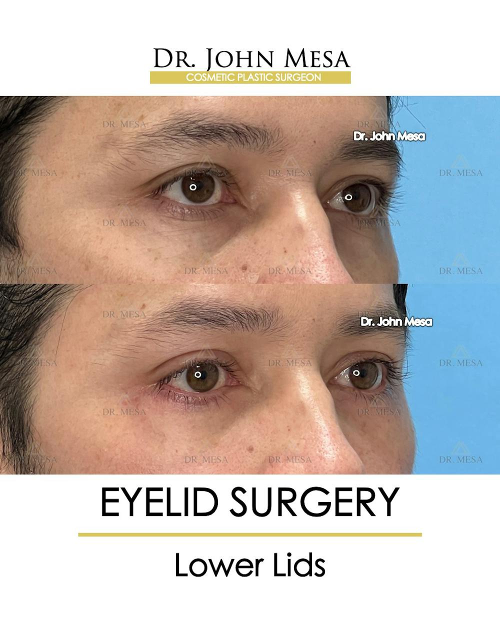 Eyelid Surgery Before & After Gallery - Patient 149297335 - Image 4