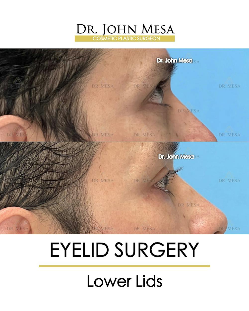 Eyelid Lift Surgery Before & After Gallery - Patient 148735149 - Image 5