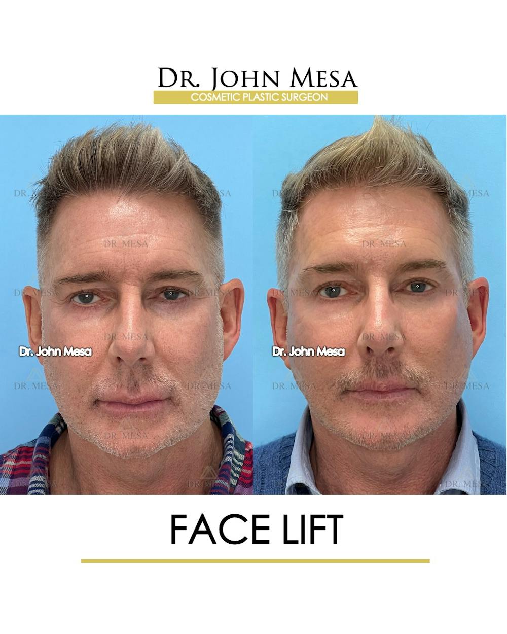 Facelift Before & After Gallery - Patient 148735216 - Image 1