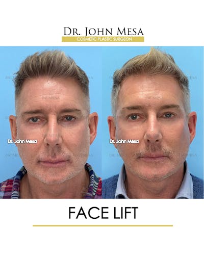 Facelift Before & After Gallery - Patient 148735216 - Image 1