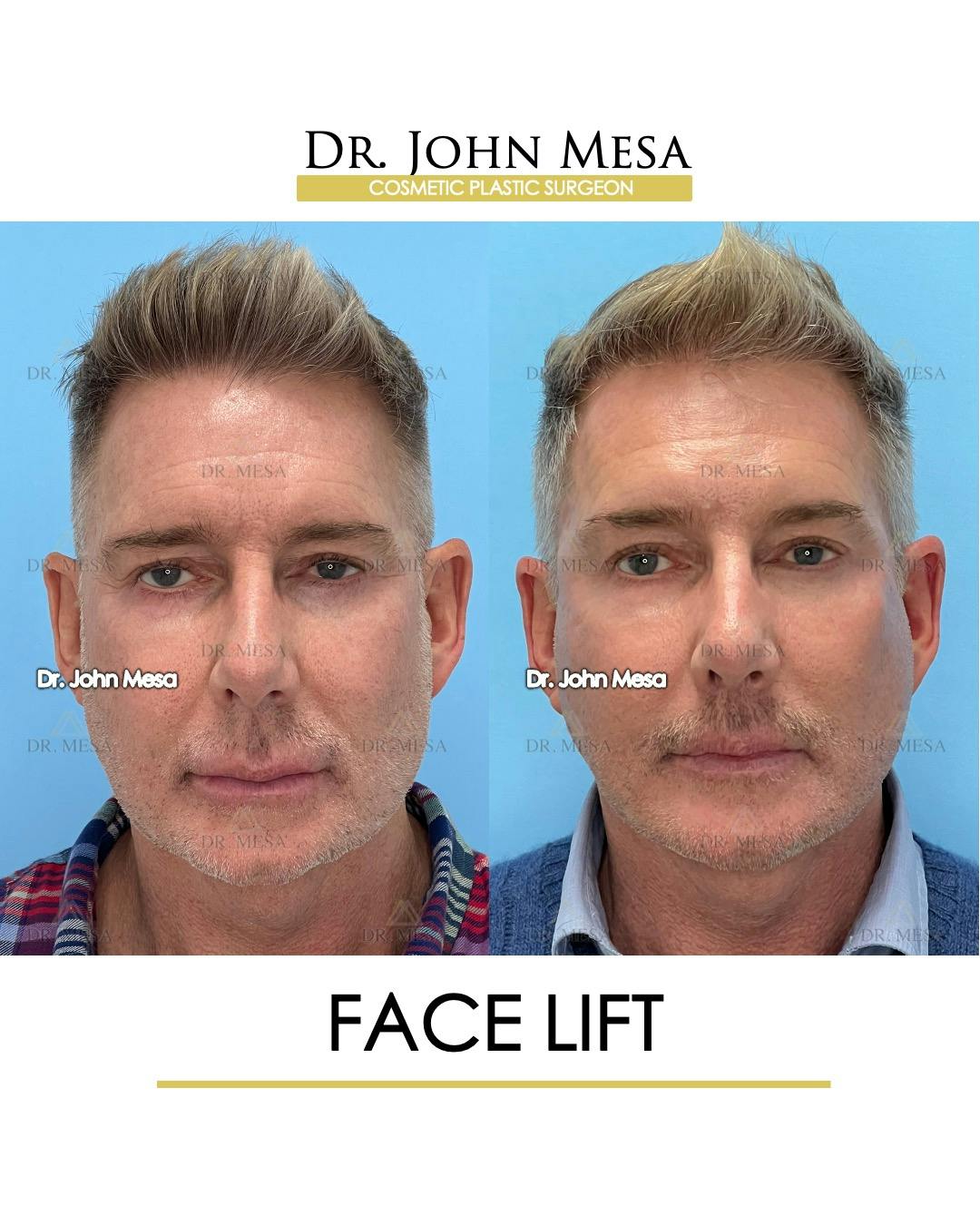 Facelift Before & After Gallery - Patient 148735216 - Image 1