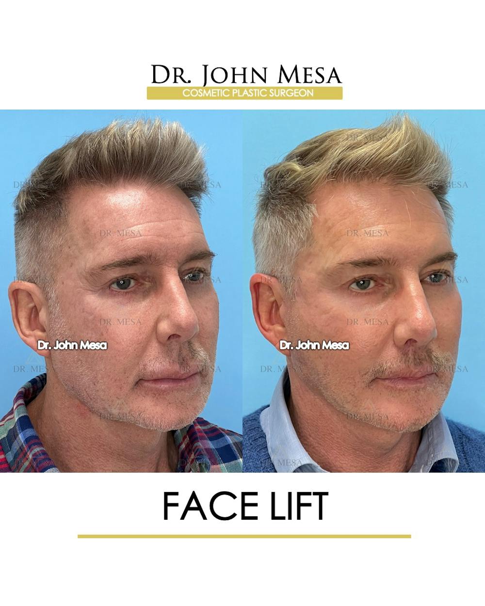 Facelift Before & After Gallery - Patient 148735216 - Image 2